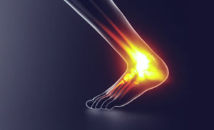 Achilles Tendinopathy - Identification and Management