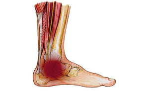 Tibialis Posterior Dysfunction - Identification and Management